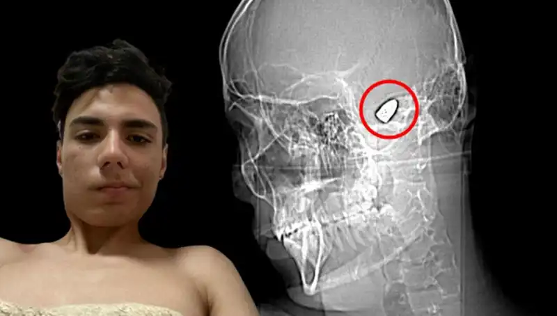 Hayatını Tehlikeye Atan Genç: Kafasında Patlayıcı ile Yaşıyor