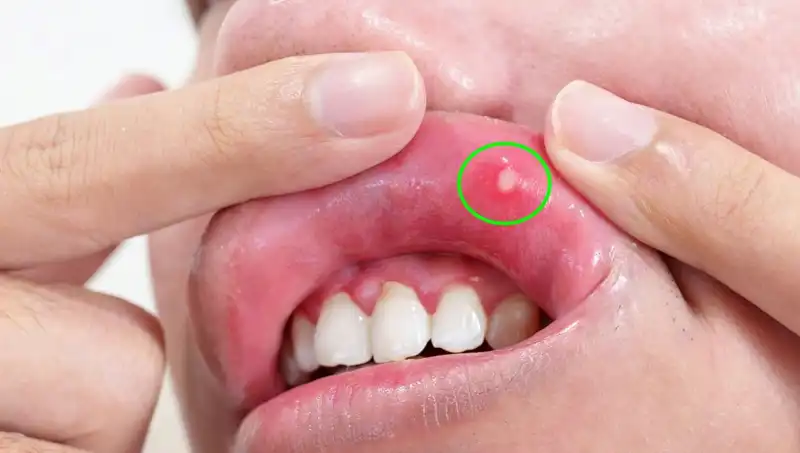 B Vitamini Eksikliğini Gösteren 5 Belirgin Belirti ve Çözüm Yolları